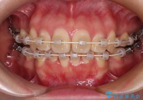 口元の突出感を改善したい。リンガルアーチを併用した抜歯矯正の治療中