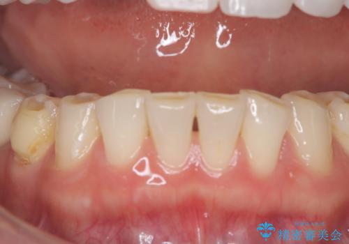 歯のホワイトニングの症例 治療前