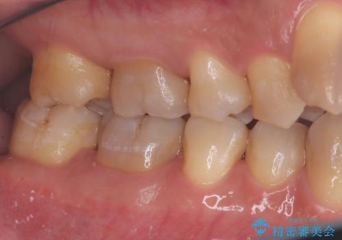 歯周病治療とエアーフローの治療後