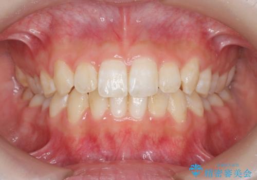 前歯のねじれを治したい マウスピース矯正治療の治療中