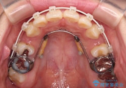 口元の突出感を改善したい。リンガルアーチを併用した抜歯矯正の治療中
