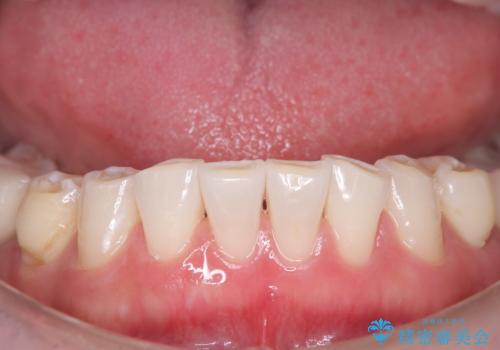 歯のホワイトニングの症例 治療後