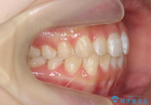 前歯のねじれを治したい マウスピース矯正治療の治療中