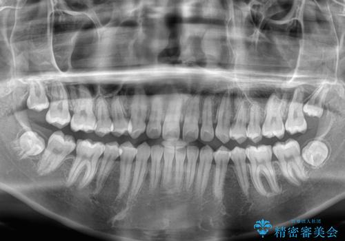 気になるすきっ歯を短期間で改善 インビザライン矯正の治療前