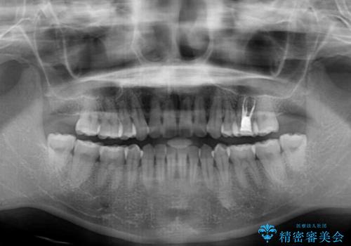 後戻りをインビザラインでスッキリした口元にの治療前