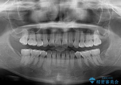 抜歯矯正の軽度後戻りを解消 インビザライン矯正の治療前