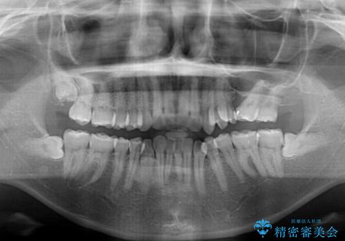 インビザラインによる矯正治療と奥歯のインプラント治療の治療前