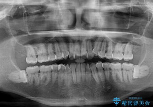 前歯のクロスバイト インビザラインによる矯正治療の治療前