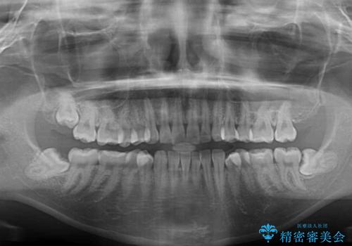 【モニター】突出した前歯 補助装置を併用したインビザライン矯正の治療前