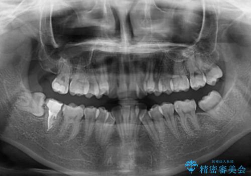 上下の八重歯とクロスバイト ワイヤー装置での抜歯矯正の治療前