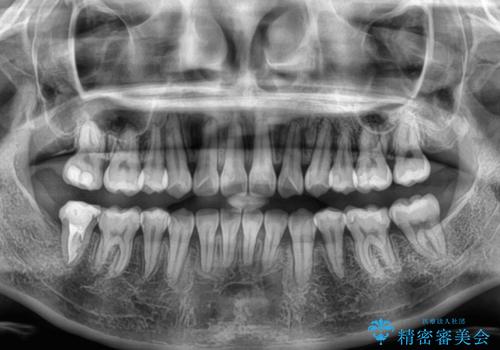上下の八重歯とクロスバイト ワイヤー装置での抜歯矯正の治療後