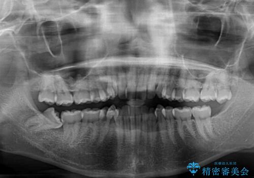 前歯のデコボコとクロスバイト ワイヤー装置での抜歯矯正の治療前