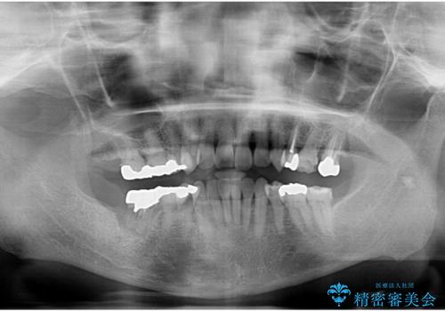 食いしばりが強い 歯周病全顎治療の治療前