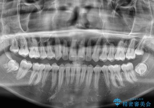 気になるすきっ歯を短期間で改善 インビザライン矯正の治療後
