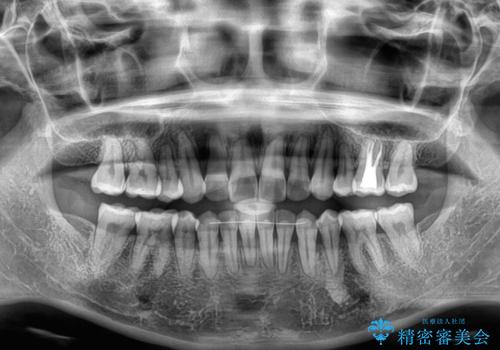 後戻りをインビザラインでスッキリした口元にの治療後