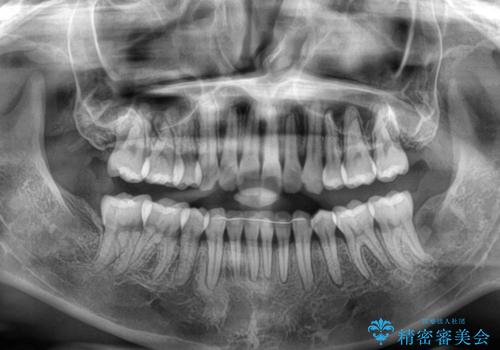 抜歯矯正の軽度後戻りを解消 インビザライン矯正の治療後
