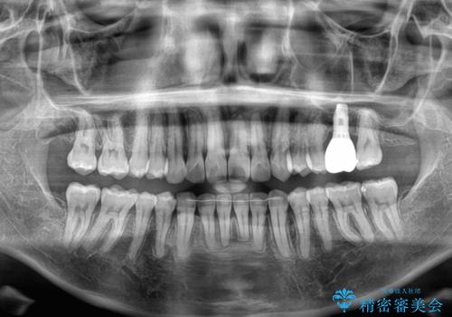 インビザラインによる矯正治療と奥歯のインプラント治療の治療後