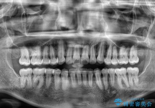 前歯のクロスバイト インビザラインによる矯正治療の治療後