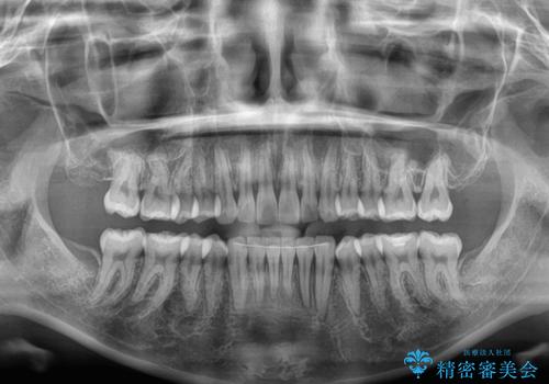 【モニター】突出した前歯 補助装置を併用したインビザライン矯正の治療後