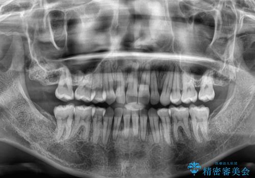 前歯のデコボコとクロスバイト ワイヤー装置での抜歯矯正の治療後