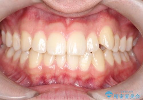 「インビザラインで八重歯をきれいに改善|遠心移動とIPRでバランスの良い歯並びへ」の治療前