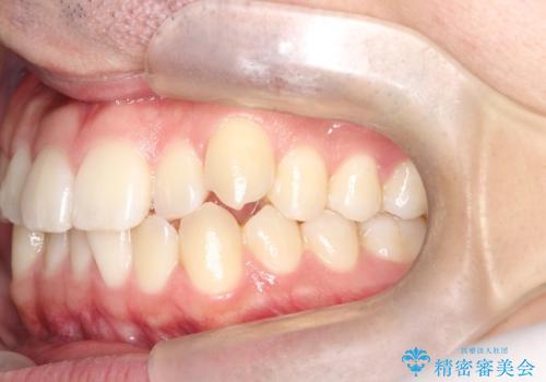 「インビザラインで八重歯をきれいに改善|遠心移動とIPRでバランスの良い歯並びへ」の治療前
