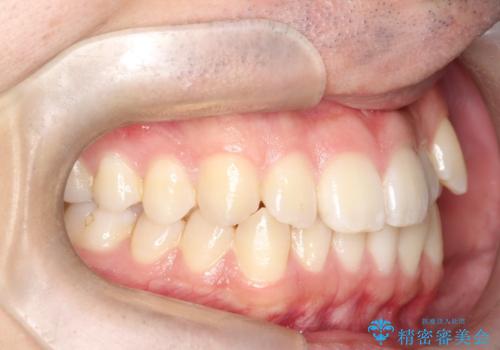 「インビザラインで八重歯をきれいに改善|遠心移動とIPRでバランスの良い歯並びへ」の治療前