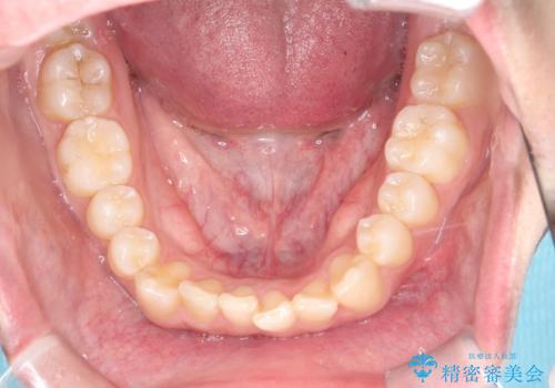 「インビザラインで八重歯をきれいに改善|遠心移動とIPRでバランスの良い歯並びへ」の治療前