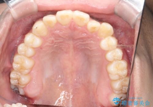 「インビザラインで八重歯をきれいに改善|遠心移動とIPRでバランスの良い歯並びへ」の治療前