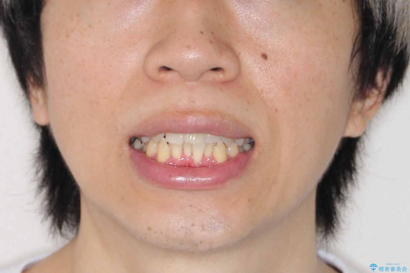 モニター|歯のでこぼこと前歯が引っ込んでいるのを治したい|抜歯矯正で歯のデコボコと正中を改善|ワイヤー矯正の治療前(顔貌)