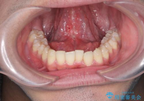 滑舌の改善 舌小帯の形成術の治療後