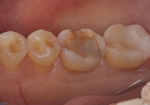 【セラミックインレー】プラスチックの劣化が気になるの治療後