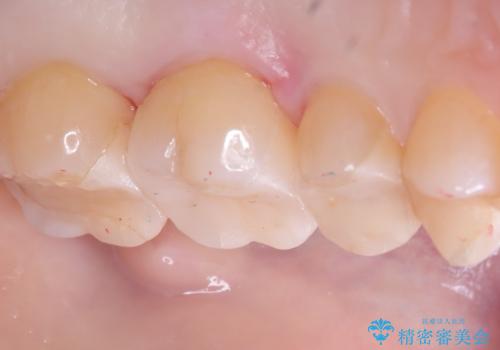 【セラミックインレー】詰め物が欠けたの治療後