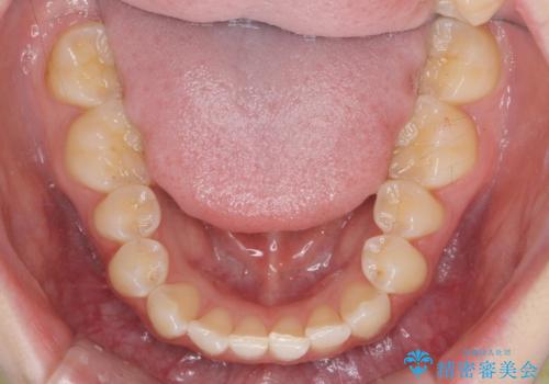 前歯のねじれを治したい マウスピース矯正治療の治療後