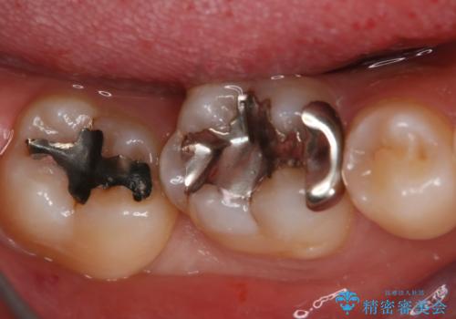 銀歯を白くしたい フルジルコニアクラウンとセラミックインレーの治療前