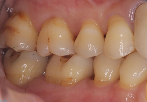 【セラミックインレー】プラスチックの劣化が気になるの治療前