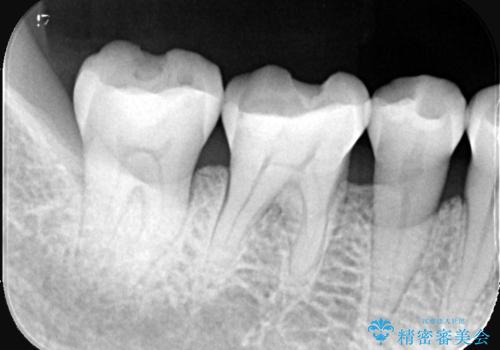 【セラミックインレー】プラスチックの劣化が気になるの治療前