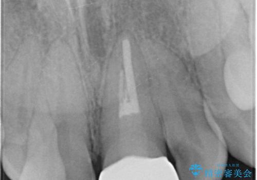 前歯の見た目が気になる。の治療後