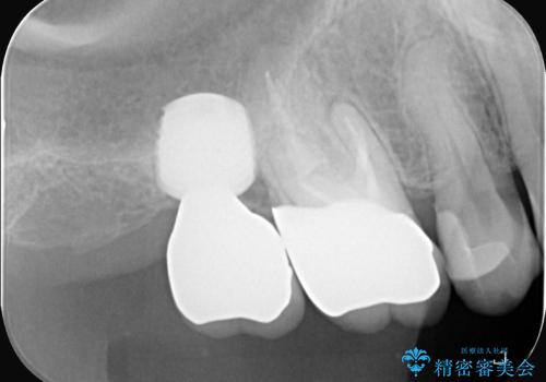 右の奥歯を機能回復|再根管治療とインプラントでしっかり噛める歯への治療後