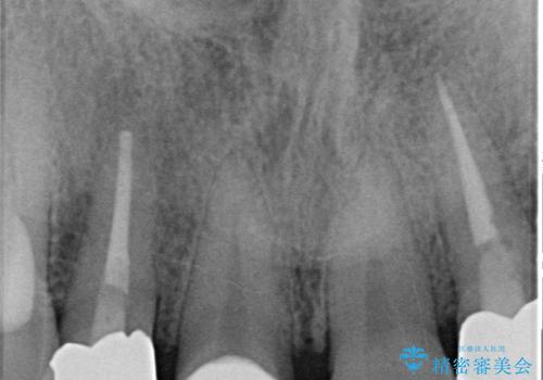 前歯のセラミッククラウン 詰め物が取れたの治療後
