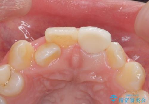 前歯の見た目が気になる。の治療後