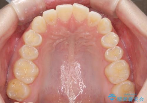 前歯のねじれを治したい マウスピース矯正治療の治療後