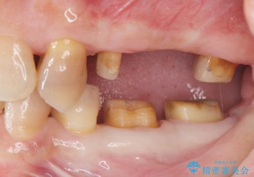 食いしばりが強い 歯周病全顎治療の治療中