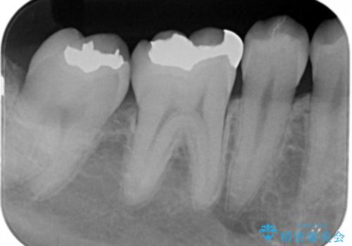 銀歯を白くしたい フルジルコニアクラウンとセラミックインレーの治療前