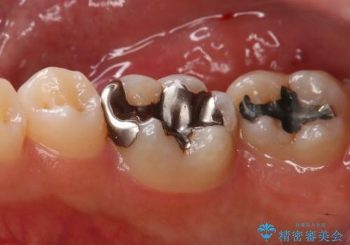 銀歯を白くしたい フルジルコニアクラウンとセラミックインレーの治療前