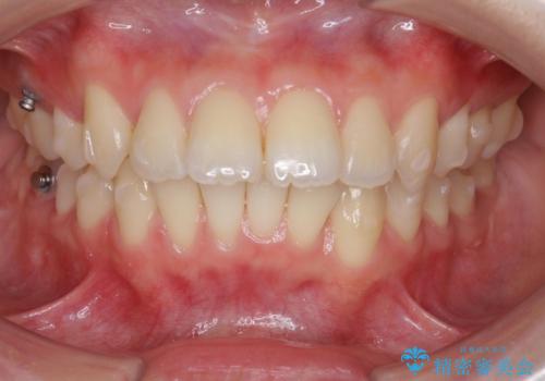 突き出た前歯の改善!マウスピースで再矯正の治療中