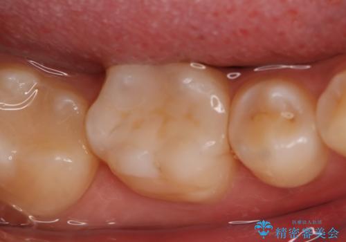 銀歯を白くしたい フルジルコニアクラウンとセラミックインレーの治療後