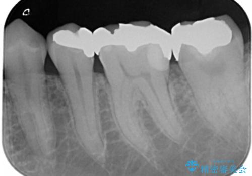 フルジルコニアクラウンによる銀歯のやり変えの治療前