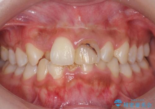 前歯の見た目が気になる。の治療前