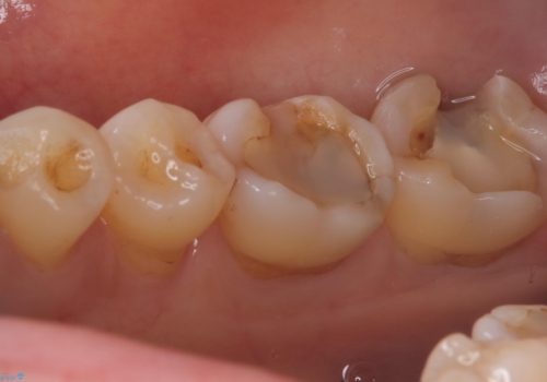 【セラミックインレー】プラスチックの劣化が気になるの治療中